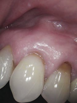Figure 8: Soft tissue at three months post-op
