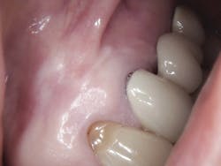 Figure 9: Soft tissue at eight months post-op Figure 9: Soft tissue at eight months post-op