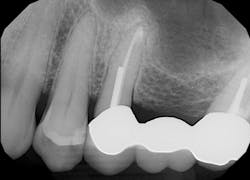 Figure 10: X-ray at eight months post-op Figure 10: X-ray at eight months post-op
