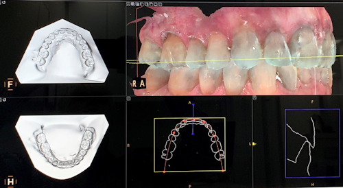 Figure 1: Intraoral scanners, especially ones with software that automatically adds bases to the digital impression, help with so much more than clear aligners.