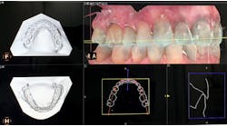 Figure 1: Intraoral scanners, especially ones with software that automatically adds bases to the digital impression, help with so much more than clear aligners.