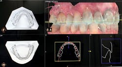 Figure 1: Intraoral scanners, especially ones with software that automatically adds bases to the digital impression, help with so much more than clear aligners. Figure 1: Intraoral scanners, especially ones with software that automatically adds bases to the digital impression, help with so much more than clear aligners.