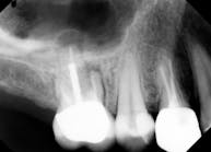 Figure 1: Tooth No. 3 with failing endo requiring extraction (All case photos compliments of Dr. Calvin Bessonet)