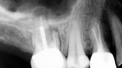 Figure 1: Tooth No. 3 with failing endo requiring extraction (All case photos compliments of Dr. Calvin Bessonet)