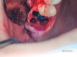 Figure 2: Postextraction reveals a buccal defect due to the necrotic extracted tooth Figure 2: Postextraction reveals a buccal defect due to the necrotic extracted tooth