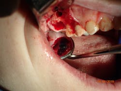 Figure 3. Implant was placed in the septal area and grafting was placed to insulate the implant from the buccal defect. A slight internal sinus bump was performed as the implant was inserted via the rounded end of the implant and aggressive threading which allowed for high primary stability (MorsTorq: IH Biomedical). Figure 3. Implant was placed in the septal area and grafting was placed to insulate the implant from the buccal defect. A slight internal sinus bump was performed as the implant was inserted via the rounded end of the implant and aggressive threading which allowed for high primary stability (MorsTorq: IH Biomedical).