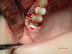 Figure 4: Site after grafting and nonresorbable high-density polytetrafluoroethylene (PTFE) membrane placement Figure 4: Site after grafting and nonresorbable high-density polytetrafluoroethylene (PTFE) membrane placement