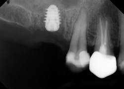 Figure 5: Radiograph of final implant placement for No. 3 Figure 5: Radiograph of final implant placement for No. 3