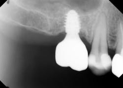 Figure 6: Final screw-retained zirconia restoration utilizing the titanium abutment/transfer that comes packaged with the implant Figure 6: Final screw-retained zirconia restoration utilizing the titanium abutment/transfer that comes packaged with the implant