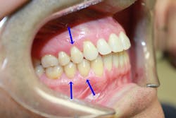 Pre- and postoperative class V cervical lesions restored with GC Fuji Automix LC. Courtesy of Jennifer Bell, DDS. Pre- and postoperative class V cervical lesions restored with GC Fuji Automix LC. Courtesy of Jennifer Bell, DDS.