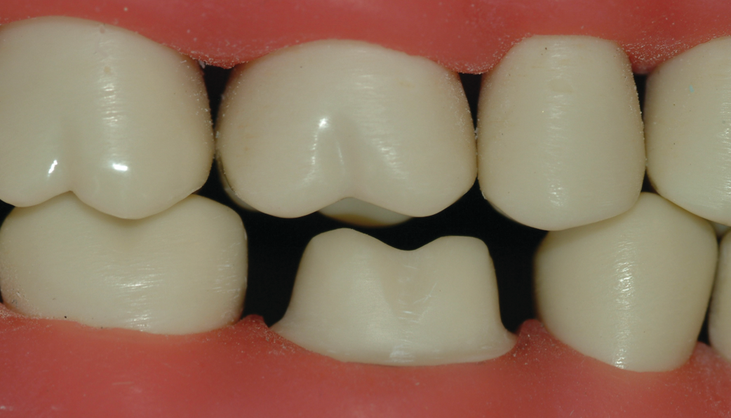Figura 1: Muchas preparaciones de coronas de circonio no se están realizando a un nivel aceptable. Lea las características deseables en el cuerpo de este artículo.