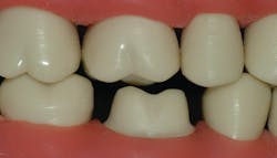 Figure 1: Many zirconia crown preparations are not being made to an acceptable level. Read the desirable characteristics in the body of this article.