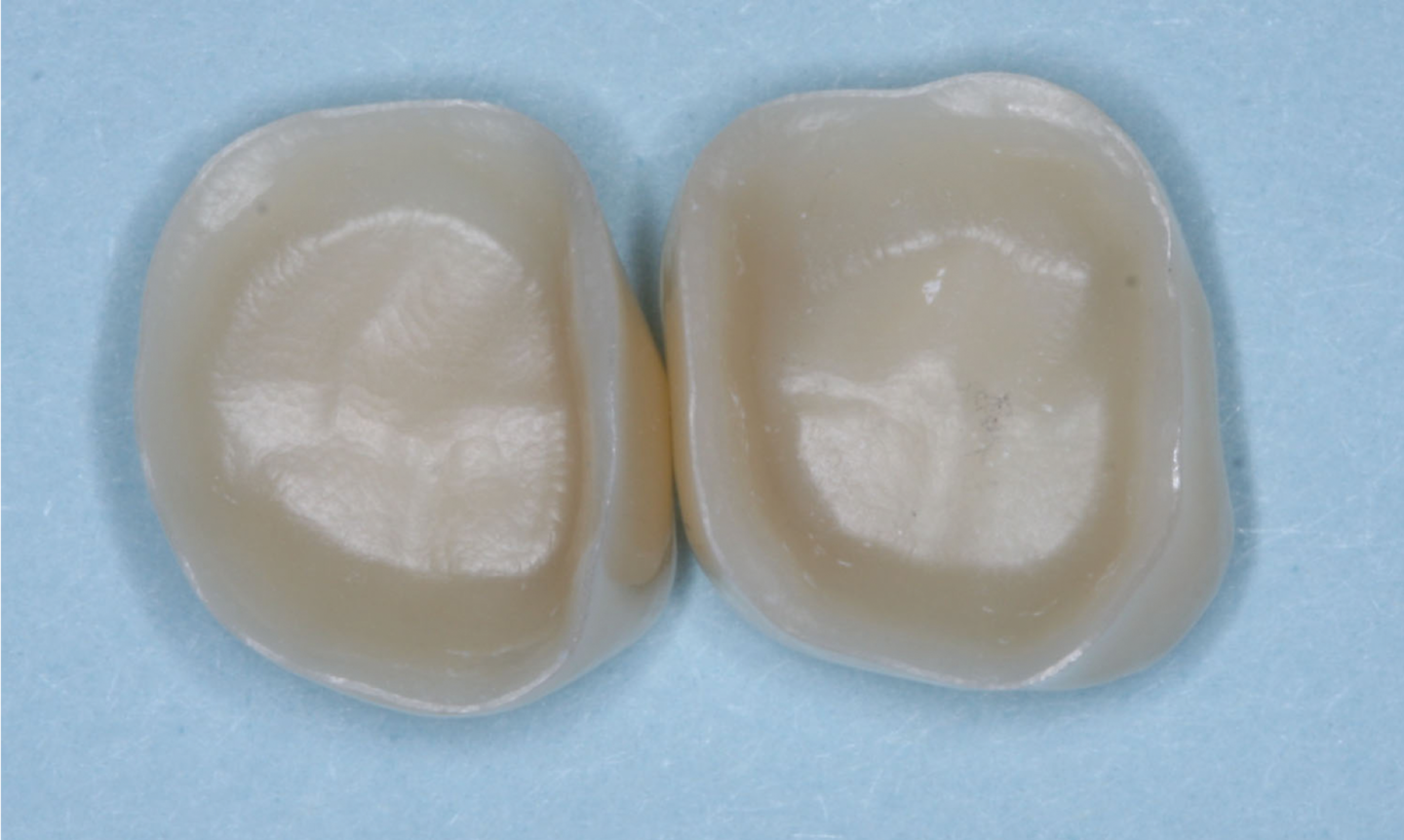 Figure 2 : Les surfaces internes de la plupart des couronnes en zircone sont lisses et n'ont pas l'effet luttant nécessaire. Rendre rugueuses les surfaces internes avec un diamant grossier ainsi que les surfaces externes de la préparation. Veillez à utiliser une zircone de classe 5 3Y, sinon vous risquez de casser la couronne.