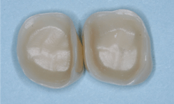 Figure 2: The internal surfaces of most zirconia crowns are smooth and lack the luting effect necessary. Roughen the internal surfaces with a coarse diamond as well as the external surfaces of the prep. Be sure to use a 3Y class 5 zirconia, or you may break the crown.