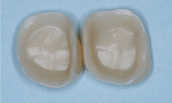 Figure 2: The internal surfaces of most zirconia crowns are smooth and lack the luting effect necessary. Roughen the internal surfaces with a coarse diamond as well as the external surfaces of the prep. Be sure to use a 3Y class 5 zirconia, or you may break the crown. Figure 2: The internal surfaces of most zirconia crowns are smooth and lack the luting effect necessary. Roughen the internal surfaces with a coarse diamond as well as the external surfaces of the prep. Be sure to use a 3Y class 5 zirconia, or you may break the crown.