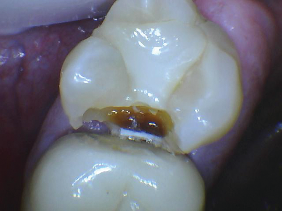 Figura 3: Observe el contacto abierto entre el primer y el segundo molar del maxilar. Aunque la mayoría de las marcas de sensores digitales no suelen identificar la caries, como en este caso, la lesión mayor es evidente. No deje zonas de contacto abiertas.