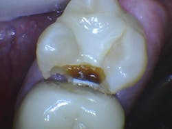 Figure 3: Note the open contact between the maxillary first and second molars. Although most brands of digital sensors often do not identify caries, as in this case, the major lesion is evident. Do not leave open contact areas.