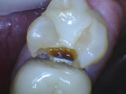 Figure 3: Note the open contact between the maxillary first and second molars. Although most brands of digital sensors often do not identify caries, as in this case, the major lesion is evident. Do not leave open contact areas. Figure 3: Note the open contact between the maxillary first and second molars. Although most brands of digital sensors often do not identify caries, as in this case, the major lesion is evident. Do not leave open contact areas.