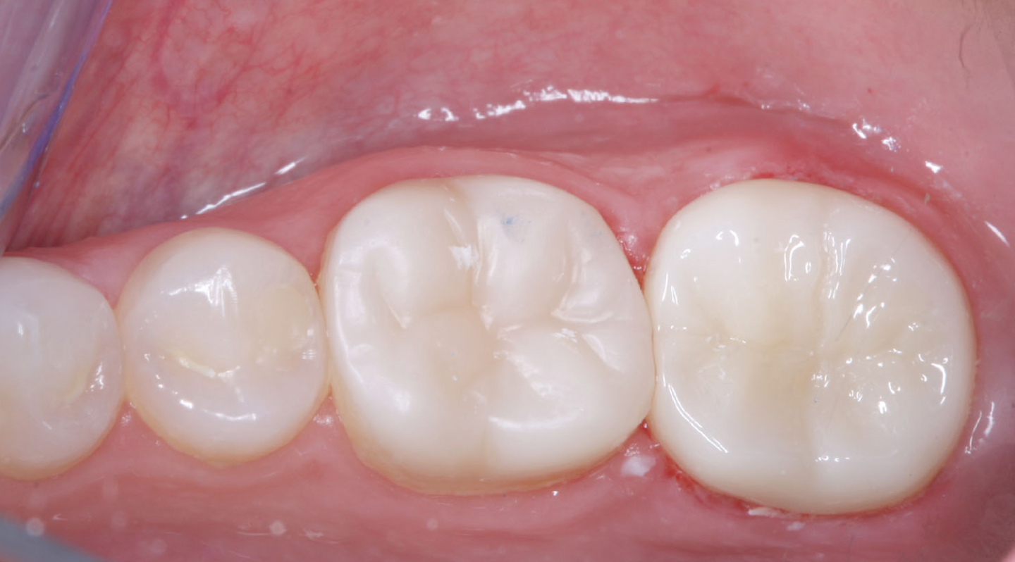 Figure 4 : La couleur de la plupart des couronnes en zircone est trop claire, malgré la demande de la bonne couleur. Observez les molaires dans ce cas. La façon de surmonter ce problème est indiquée dans cet article.