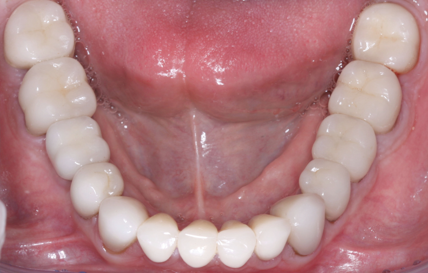 Figura 5: Los molares en este caso son de zirconia 3Y, y el resto de las coronas son de IPS e.max. Con la técnica descrita en este artículo se puede conseguir que el óxido de circonio 3Y sea estético.