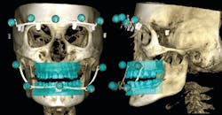 Figure 1: Front and lateral view with upper and lower fitted STL models of a CBCT captured with Planmeca 4D Jaw Motion technology.