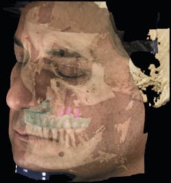 Figure 2: Planmeca Romexis software allows for the merging of the 3-D facial scan (Planmeca ProFace) and fitted STL models from Planmeca Emerald intraoral scanner or ProMax 3D impression scanning with the CBCT scan for a full virtual patient. Three implants, abutments, and crowns are virtually planned for the purpose of designing an implant guide that is ready for printing by a 3-D printer or your favorite lab.