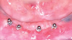 Figure 1: Small-diameter implants placed in an 80-year-old patient, loaded immediately on placement, and now serving successfully for many years Figure 1: Small-diameter implants placed in an 80-year-old patient, loaded immediately on placement, and now serving successfully for many years