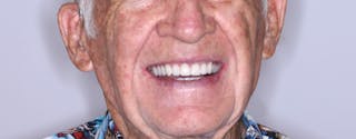 Figure 3: A happy patient with his implant-supported denture
