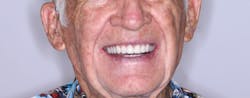 Figure 3: A happy patient with his implant-supported denture Figure 3: A happy patient with his implant-supported denture