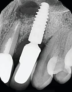 Figure 1: Radiograph of an infected implant coming from an adjacent tooth with a failed root canal. Both tooth and implant needed to be removed.