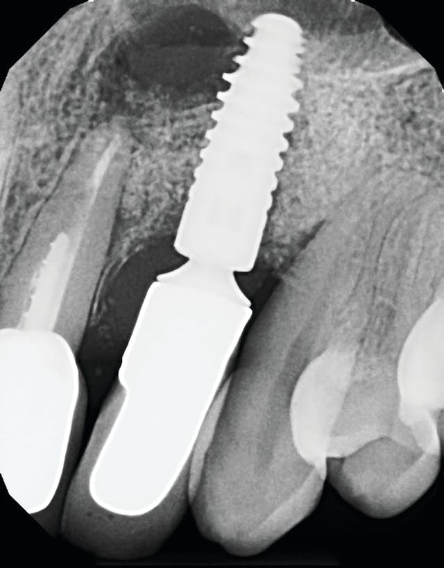 Figure 1: Radiograph of an infected implant coming from an adjacent tooth with a failed root canal. Both tooth and implant needed to be removed.