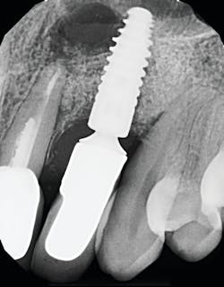 Figure 1: Radiograph of an infected implant coming from an adjacent tooth with a failed root canal. Both tooth and implant needed to be removed. Figure 1: Radiograph of an infected implant coming from an adjacent tooth with a failed root canal. Both tooth and implant needed to be removed.
