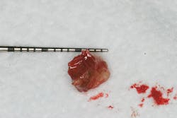 Figure 2: Cement removed from an implant that shows embedded bacteria Figure 2: Cement removed from an implant that shows embedded bacteria