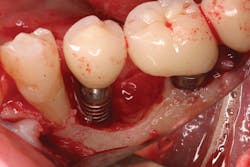 Figure 3: Bone loss around an implant that had an infection from the cement shown in Figure 2 Figure 3: Bone loss around an implant that had an infection from the cement shown in Figure 2