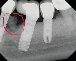 Figure 4: Radiograph of the implant shown in Figure 3 with evidence of subgingival cement Figure 4: Radiograph of the implant shown in Figure 3 with evidence of subgingival cement