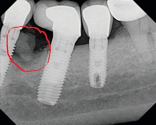 Figure 4: Radiograph of the implant shown in Figure 3 with evidence of subgingival cement