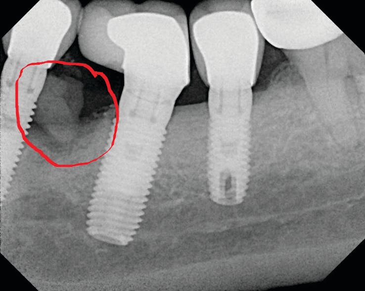 Figure 4: Radiograph of the implant shown in Figure 3 with evidence of subgingival cement