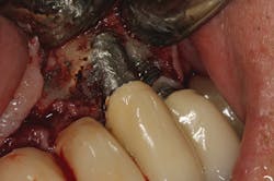 Figure 5: An implant that was treated with implantoplasty during peri-implantitis treatment, which resulted in titanium particles being embedded in the soft tissue Figure 5: An implant that was treated with implantoplasty during peri-implantitis treatment, which resulted in titanium particles being embedded in the soft tissue