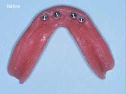 Figure 2: The mandibular denture before and after placing the retentive flexible &ldquo;O&rdquo; rings