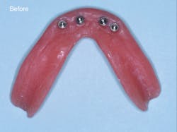Figure 2: The mandibular denture before and after placing the retentive flexible “O” rings Figure 2: The mandibular denture before and after placing the retentive flexible “O” rings