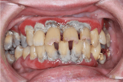 These two intraoral photos were taken with a Canon EOS Rebel fitted with a 100 mm macro lens, which is still less expensive than many name-brand intraoral cameras.