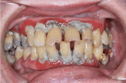 These two intraoral photos were taken with a Canon EOS Rebel fitted with a 100 mm macro lens, which is still less expensive than many name-brand intraoral cameras.