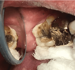 In a bind, you can even take decent intraoral photos, such as this one, with an iPhone. In a bind, you can even take decent intraoral photos, such as this one, with an iPhone.