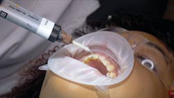 Figure 3: UniCore post and Clearfil DC Core Plus were used to create ferule effect on upper left-central incisor. Figure 3: UniCore post and Clearfil DC Core Plus were used to create ferule effect on upper left-central incisor.