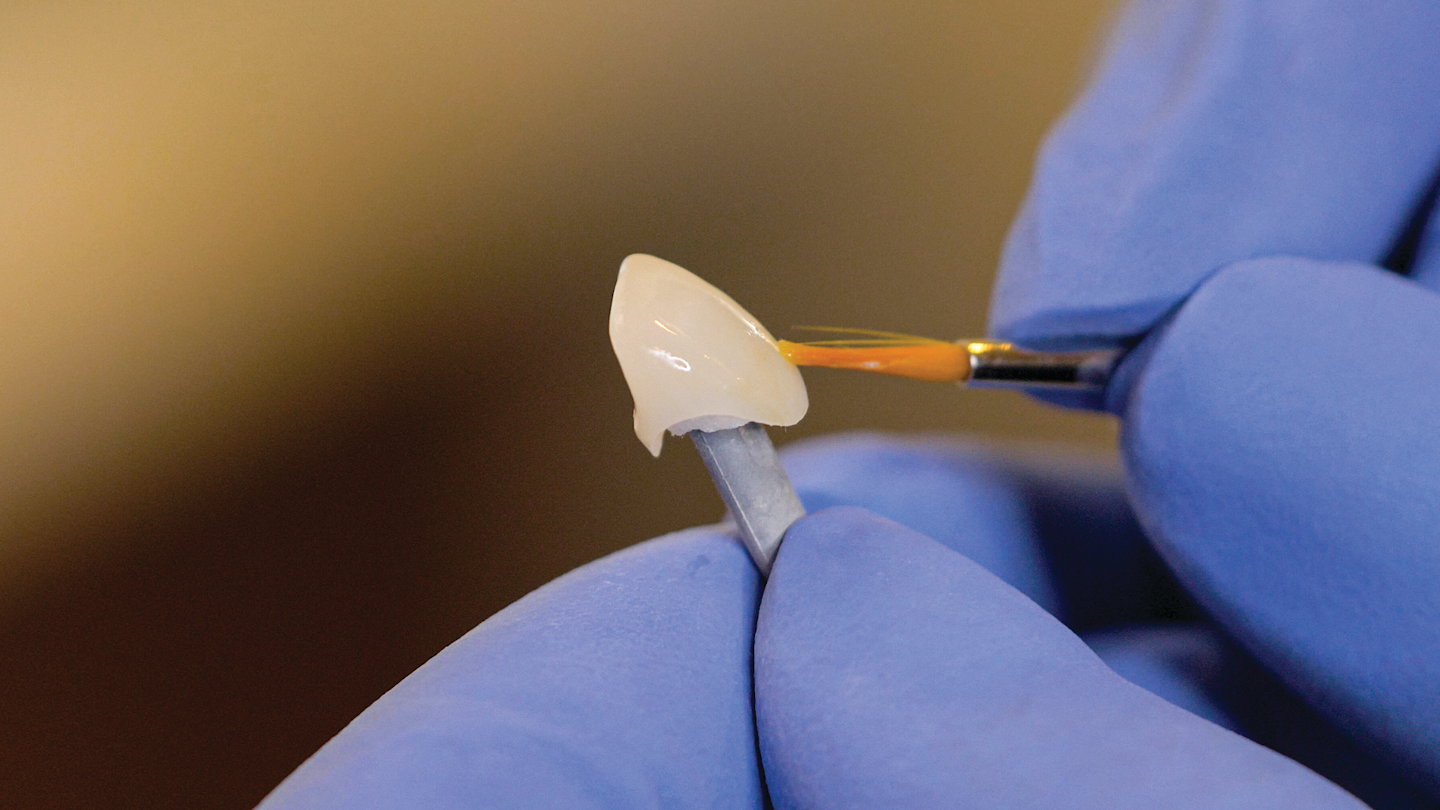 A simplified approach to cementation of bonded restorations Dental