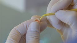 Figure 8: Glass ceramic was treated with 10% hydrofluoric acid for 60 seconds. Figure 8: Glass ceramic was treated with 10% hydrofluoric acid for 60 seconds.