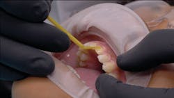 Figure 9: Clearfil Universal Bond Quick was applied for 10 seconds to each preparation. Figure 9: Clearfil Universal Bond Quick was applied for 10 seconds to each preparation.
