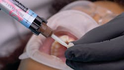 Figure 10: A thin layer of Panavia SA Cement Universal (translucent shade) was injected into the restoration. Figure 10: A thin layer of Panavia SA Cement Universal (translucent shade) was injected into the restoration.