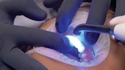 Figure 11: An LED curing light was used for a three-second tack-cure to harden the resin into a gel form. Figure 11: An LED curing light was used for a three-second tack-cure to harden the resin into a gel form.