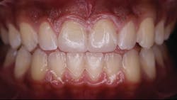 Figure 13: Final restorations Figure 13: Final restorations